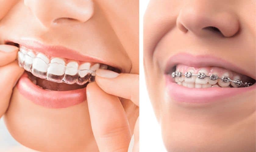 Invisalign vs. Traditional Braces