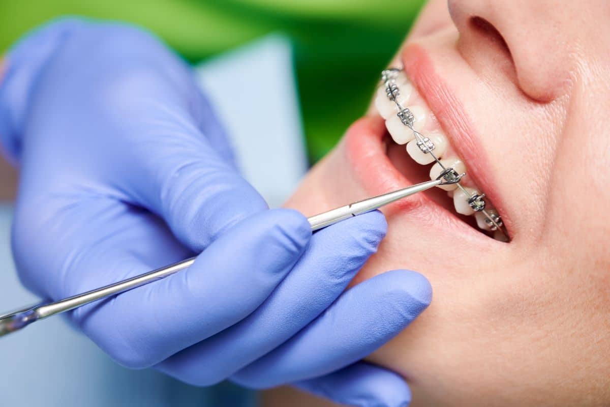 Maintaining good oral hygiene with braces