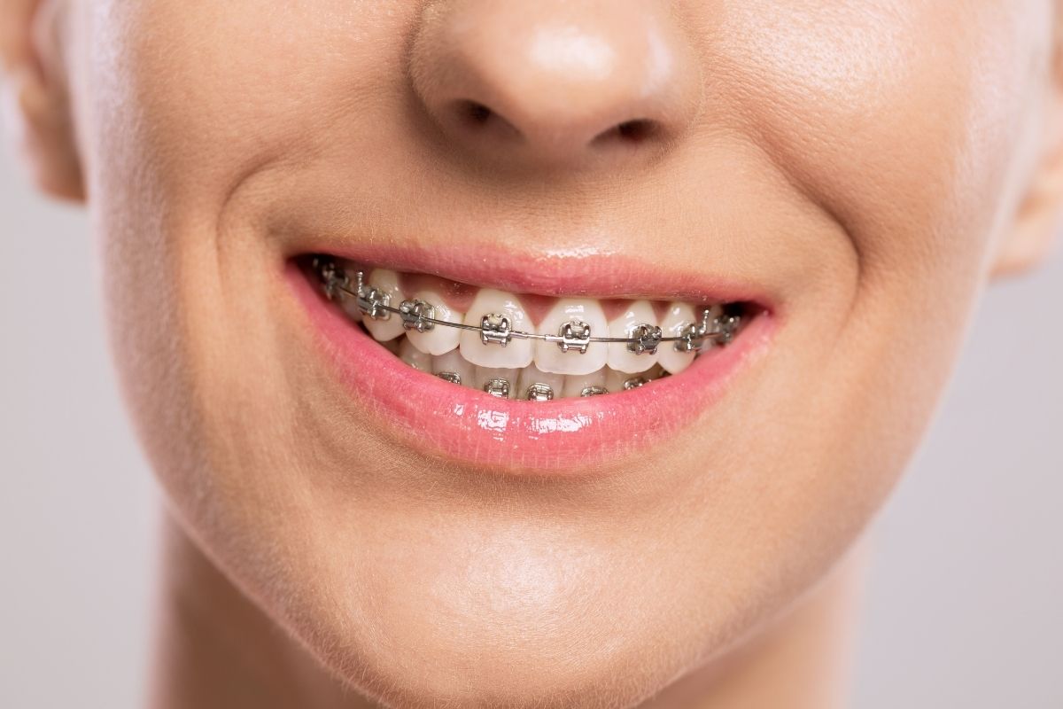 Holistic Titanium Braces: The Future of Natural Orthodontic Care