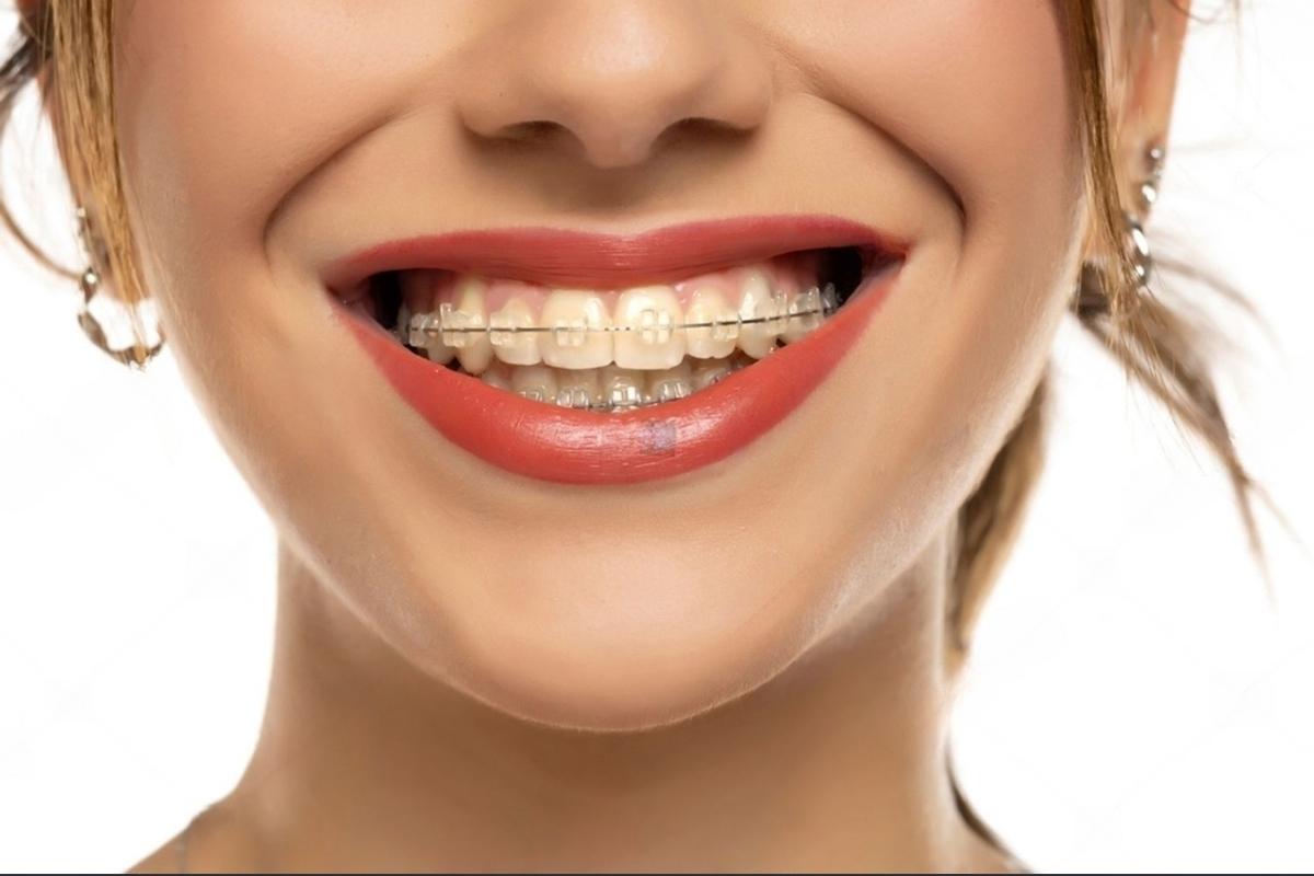 How Clear Braces Work: Technology Behind Tooth-Colored Orthodontics
