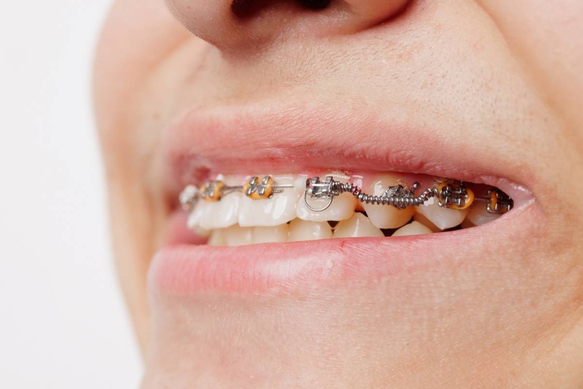 Do I need jaw surgery with braces