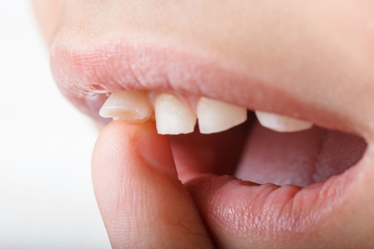 extra tooth in child upper jaw