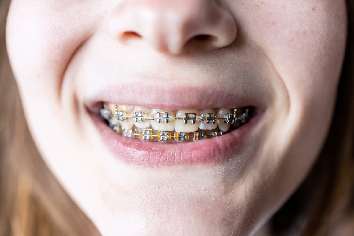 Braces in Rockdale